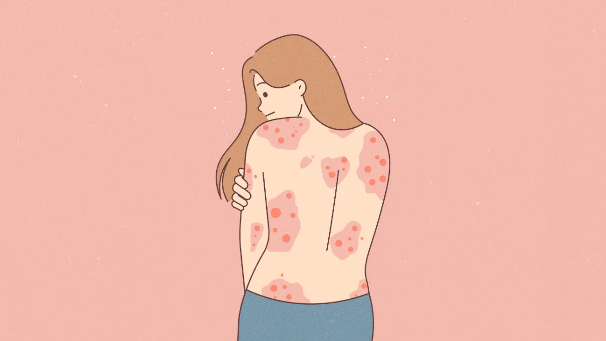 Positive Affirmations For Psoriasis